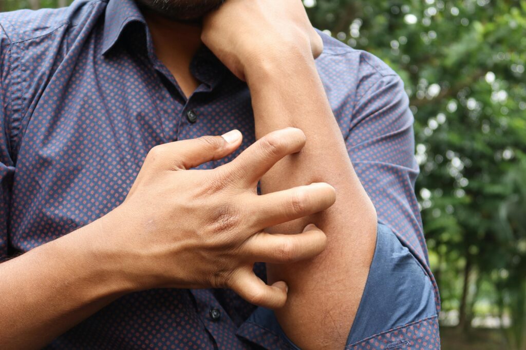 Psoriasis