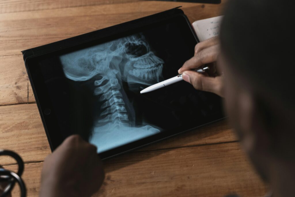 Cervical Spondylosis