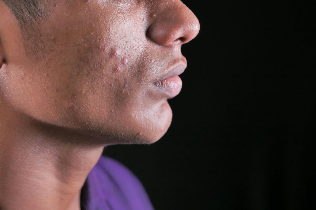 Blemishes
